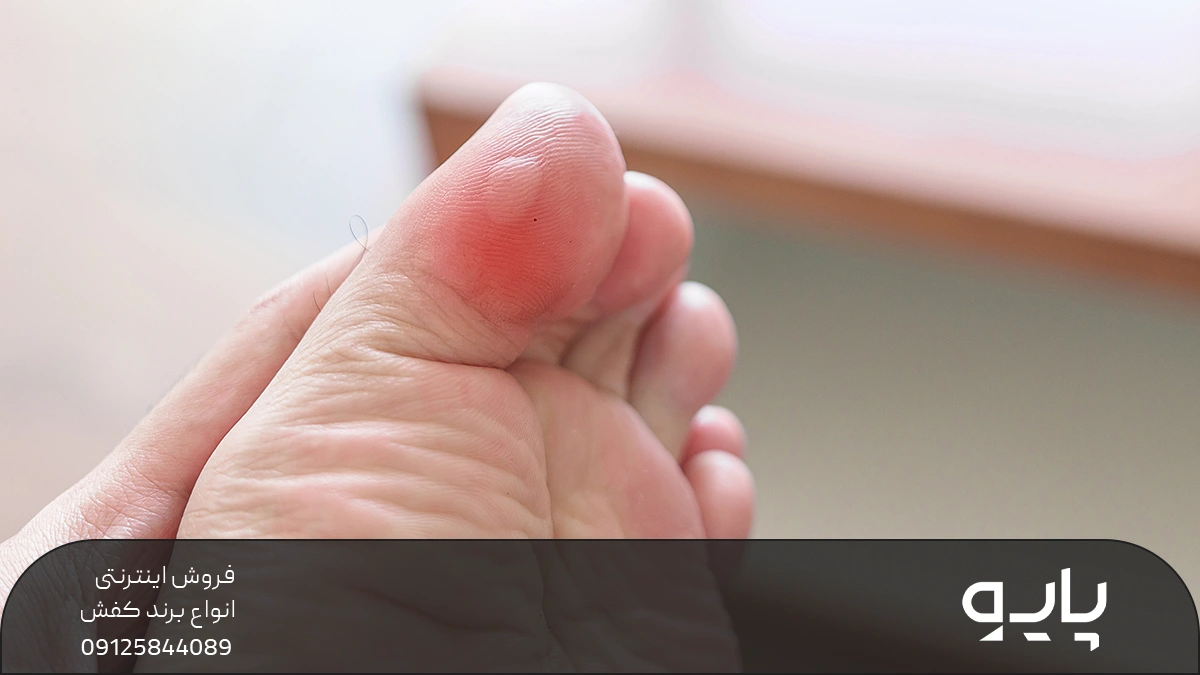 پای فردی که زیر انگشت شصت پای او تاول زده است